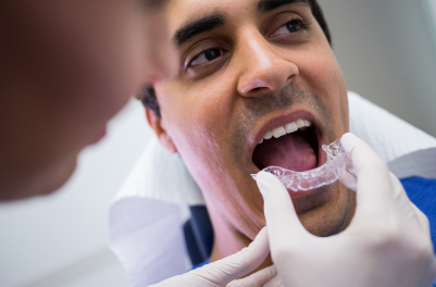Clear Aligners